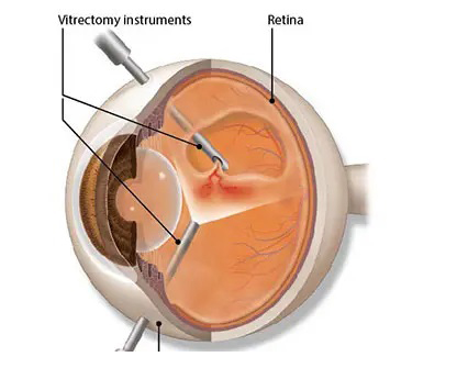 Surgical retina treatment in Medford, Grants Pass, & Roseburg, OR